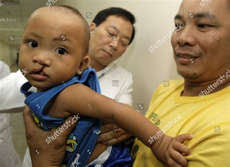 Deformity in Tagalog.